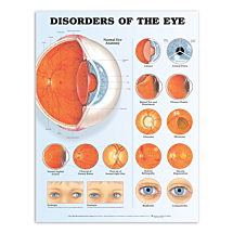 Gelamineerde kaart met aandoeningen van het oog