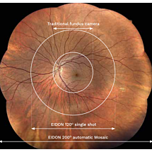 Centervue/iCare Eidon ultra-widefield module